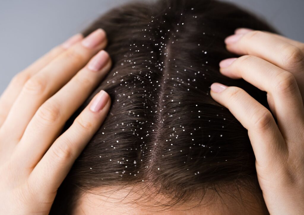 dandruff in a ladies hair