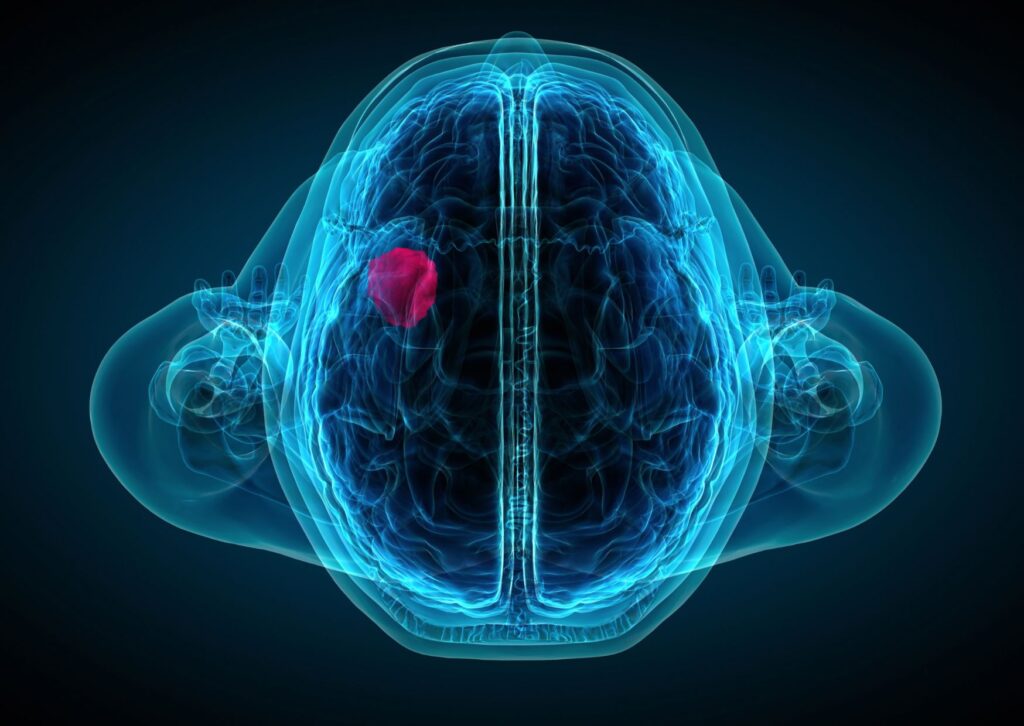 x-ray-of-a-brain-tumor